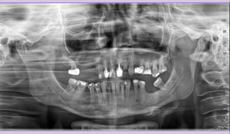 Zmiana okołowierzchołkowa w obrębie wierzchołka korzenia zęba lewa dolna 5 Zmiana okołowierzchołkowa w obrębie wierzchołka korzenia zęba lewa dolna 5