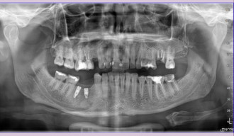 Zmiana okołowierzchołkowa w obrębie wierzchołka korzenia zęba lewa dolna 5 Zmiana okołowierzchołkowa w obrębie wierzchołka korzenia zęba lewa dolna 5