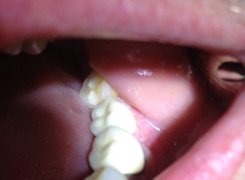 Korona porcelanowa zamocowana na implancie Korona porcelanowa zamocowana na implancie