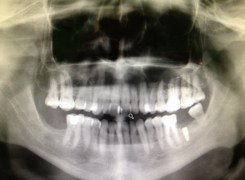 Obraz radiologiczny z widocznym wszczepionym implantem Obraz radiologiczny z widocznym wszczepionym implantem