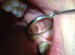 Profil wyłaniania implantu Profil wyłaniania implantu