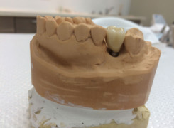 Korona porcelanowa z łącznikiem Korona porcelanowa z łącznikiem