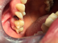 Łącznik tytanowy zamocowany na implancie Łącznik tytanowy zamocowany na implancie