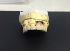 Praca wykonana na implantch - korony i most cyrkonowy - pełnocermiczne Praca wykonana na implantch - korony i most cyrkonowy - pełnocermiczne