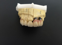 Praca wykonana na implantch - korony i most cyrkonowy - pełnocermiczne Praca wykonana na implantch - korony i most cyrkonowy - pełnocermiczne