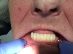 Belka pełnoceramiczna z zębami zamocowana na 4 implantach Belka pełnoceramiczna z zębami zamocowana na 4 implantach