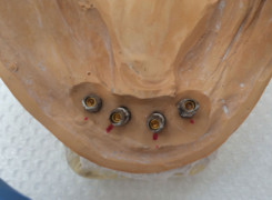 Zindywidualizowane łączniki na implantach Zindywidualizowane łączniki na implantach