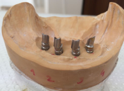 Zindywidualizowane łączniki na implantach Zindywidualizowane łączniki na implantach