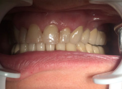 Efekt po zacementowaniu nowego mostu Efekt po zacementowaniu nowego mostu