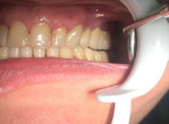 Efekt po zacementowaniu nowego mostu Efekt po zacementowaniu nowego mostu