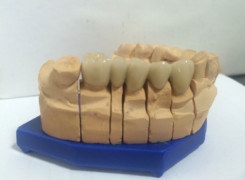 Most porcelanowy - podbudowa metalowa Most porcelanowy - podbudowa metalowa