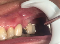 Pacjentka zglosiła się w celu wymiany mostu i uzupelnienia braku Pacjentka zglosiła się w celu wymiany mostu i uzupelnienia braku