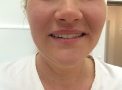 Efekt po zakończeniu leczenia Efekt po zakończeniu leczenia