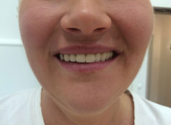 Efekt po zakończeniu leczenia Efekt po zakończeniu leczenia