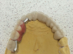 Most porcelanowy z miejscem na uzupełnenie elementem ruchomym mocowanym na zatrzaski Most porcelanowy z miejscem na uzupełnenie elementem ruchomym mocowanym na zatrzaski