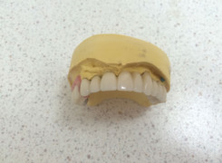 Most porcelanowy z uzupełnieniem ruchomym Most porcelanowy z uzupełnieniem ruchomym