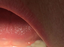 Efekt po zamocowaniu 3 punktowego mostu na implantach Efekt po zamocowaniu 3 punktowego mostu na implantach