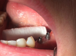 Łączninki tytanowe przykręcone do implantów przygotowane do zacementowania mostu Łączninki tytanowe przykręcone do implantów przygotowane do zacementowania mostu
