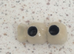 Most porcelanowy do zamocowania na implantach Most porcelanowy do zamocowania na implantach