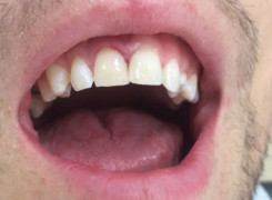 Efekt końcowy - odbudowa zęba materiałem kompozytowym Efekt końcowy - odbudowa zęba materiałem kompozytowym