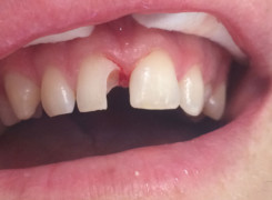 Preparacja zęba do odbudowy kosmetycznej Preparacja zęba do odbudowy kosmetycznej