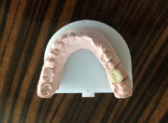 Korona pełnoceramiczna Korona pełnoceramiczna