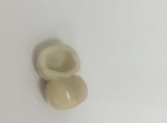 Podbudowa pełnoceramiczna mostu Podbudowa pełnoceramiczna mostu