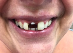 Cyrkonowa śruba gojąca Cyrkonowa śruba gojąca