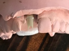 Indywidualizowany łącznik pełnoceramiczny Indywidualizowany łącznik pełnoceramiczny