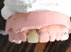 Korona pełnoceramiczna na indywidualizowanym łączniku pełnoceramicznym Korona pełnoceramiczna na indywidualizowanym łączniku pełnoceramicznym