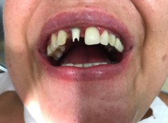 Zamontowany łącznik cyrkonowy Zamontowany łącznik cyrkonowy