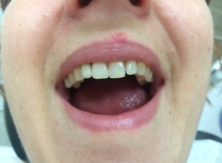 Uzupełnienie koroną cełnoceramiczną zamocowaną na implancie Uzupełnienie koroną cełnoceramiczną zamocowaną na implancie