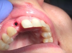 widok miejsca po implantacji przed zacementowaniem łącznika i korony widok miejsca po implantacji przed zacementowaniem łącznika i korony