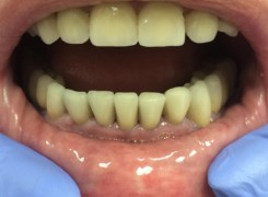 Korony porcelanowe Korony porcelanowe