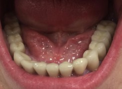 Uzupełnienie koronami porcelanowymi dolnego łuku zębowego Odcinki boczne korony na implantach Odcinek przedni korony na filarach własnych zębów Uzupełnienie koronami porcelanowymi dolnego łuku zębowego Odcinki boczne korony na implantach Odcinek przedni korony na filarach własnych zębów