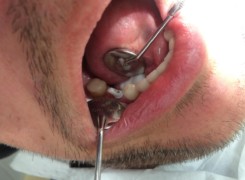 Łącznik cyrkonowy na implancie Łącznik cyrkonowy na implancie