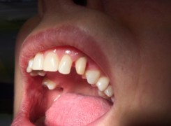 Oszlifowany ząb pod koronę pełnoceramiczną Oszlifowany ząb pod koronę pełnoceramiczną