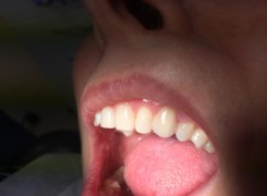 Zacementowana korona pełnoceramiczna Zacementowana korona pełnoceramiczna