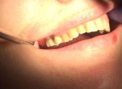 Korona na implancie Korona na implancie