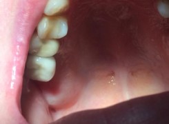 Korona na implancie Korona na implancie