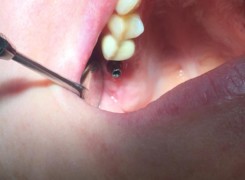 Łącznik tytanowy na którym zostanie zacementowana korona Łącznik tytanowy na którym zostanie zacementowana korona