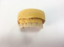 Korony pełnoceramiczne Korony pełnoceramiczne