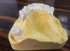 Most pełnoceramiczny - model Most pełnoceramiczny - model