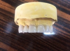 Most pełnoceramiczny -model Most pełnoceramiczny -model