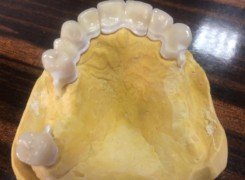 Most pełnoceramiczny -widoczne szlifowanie pod uzupełnienie protezą szkieletową Most pełnoceramiczny -widoczne szlifowanie pod uzupełnienie protezą szkieletową