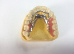 Uzupełnienie łuku górnego Korony pełnoceraiczny oraz proteza szkieletowa frezowana Uzupełnienie łuku górnego Korony pełnoceraiczny oraz proteza szkieletowa frezowana