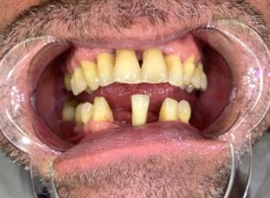 Braki zębowe w odcinku przednim luk dolny