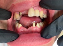 Pacjent po wypadku i utracie zębów przednich w obydwu lukach