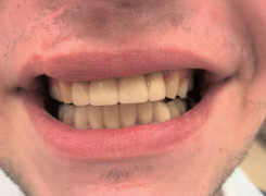 Praca końcowa w uśmiechu Korony i mosty pełnoceramiczne