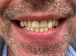 Uzupełnienie zębów koronami pełnoceramicznymi łuk dolny